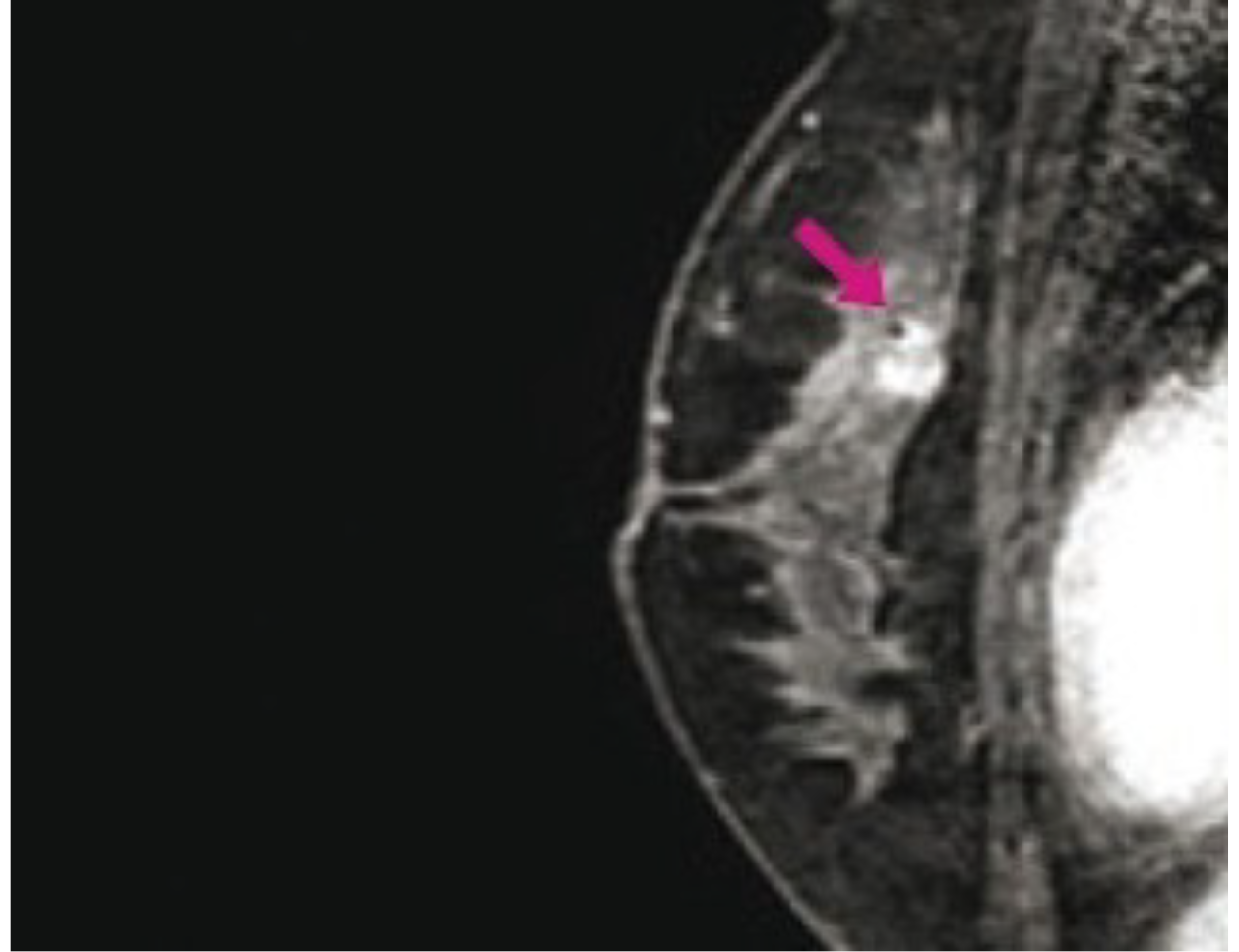 CÁNCER DE MAMA