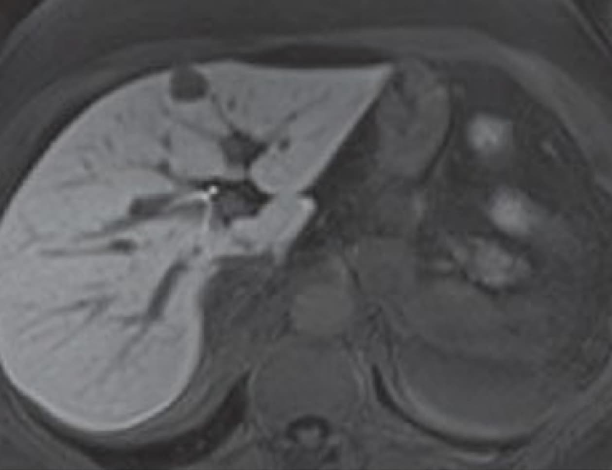 CÁNCER HEPÁTICO