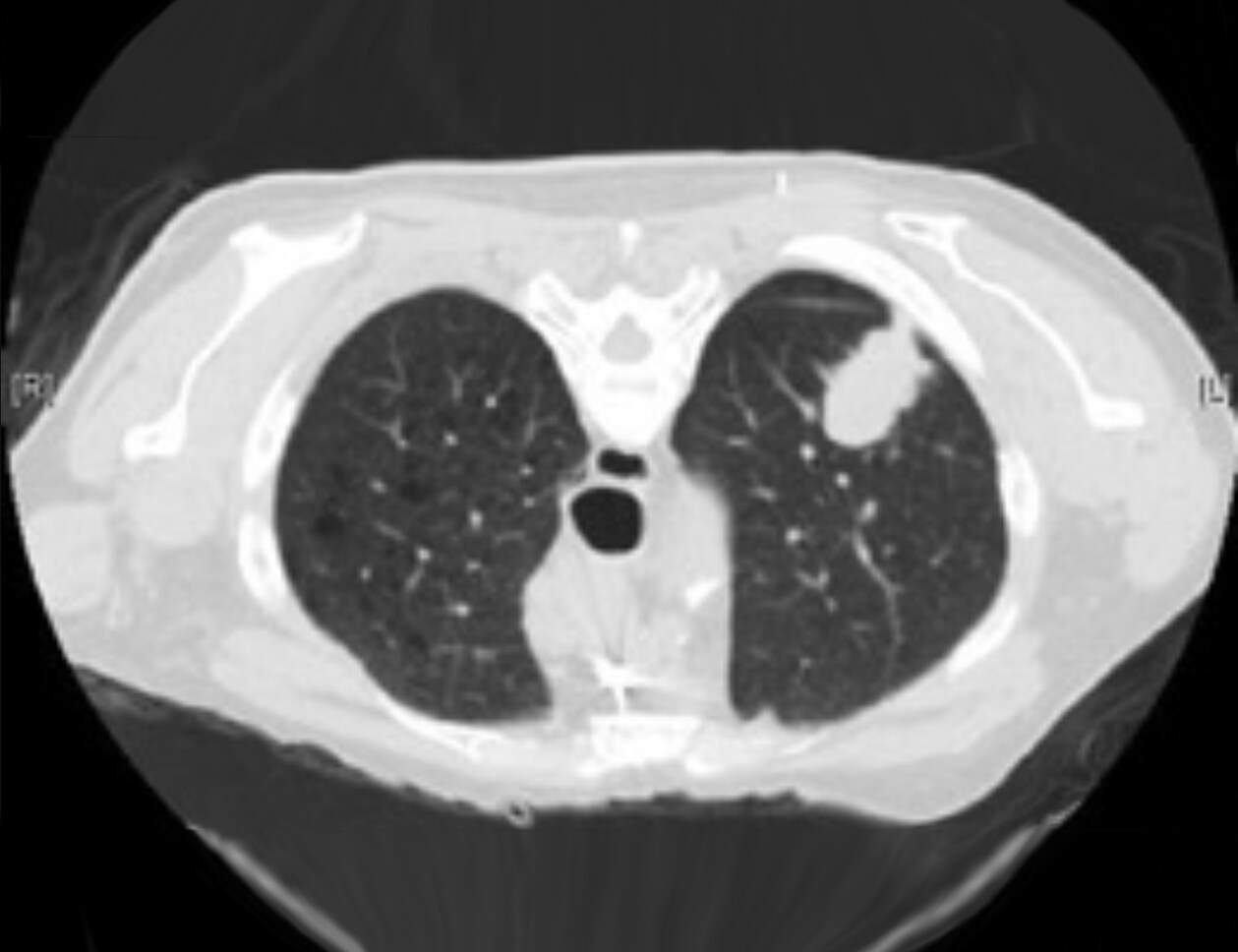 CÁNCER HEPÁTICO