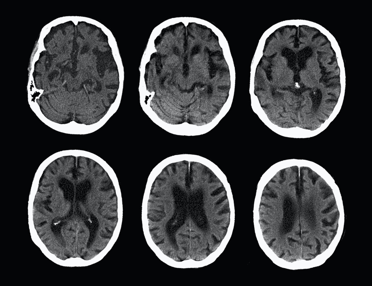 CÁNCER CEREBRAL/SNC